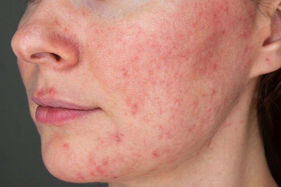 Probiotics for rosacea 